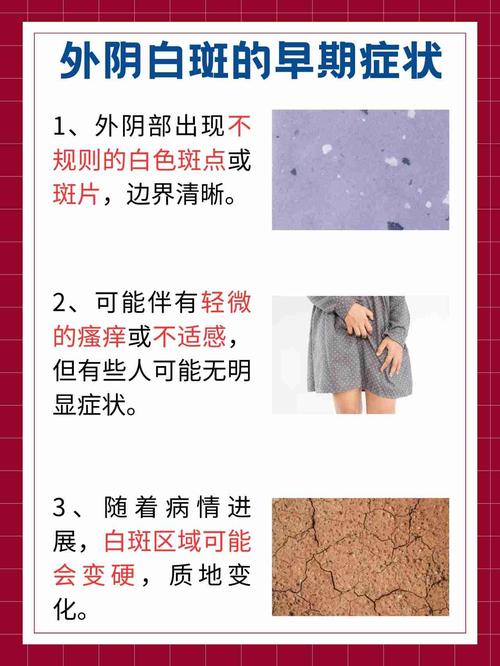 什么是妇科白班:妇科白斑是什么症状
